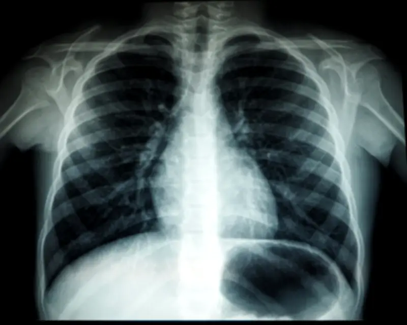 Kes TB Pertama Luar Zon Kota Tinggi: Murid Sekolah Rendah Pontian Disahkan Positif