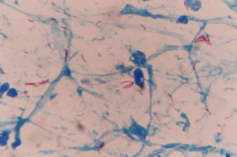 Tiga Pelajar Johor Pulih Daripada TB, Empat Lagi Masih Dalam Kuarantin