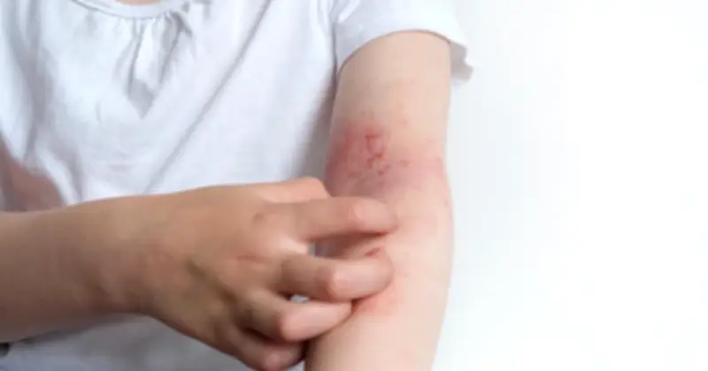 Rawatan Eksim Segera Boleh Memburukkan Keadaan, Amaran Pakar Dermatologi