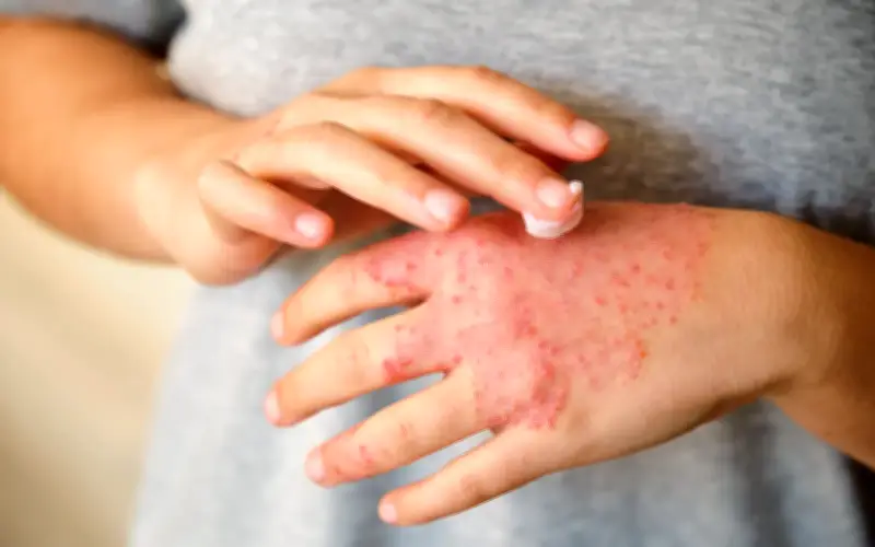 Derita Luar dan Dalam: Perjuangan Dua Wanita Penghidap Ekzema Melawan Stigma