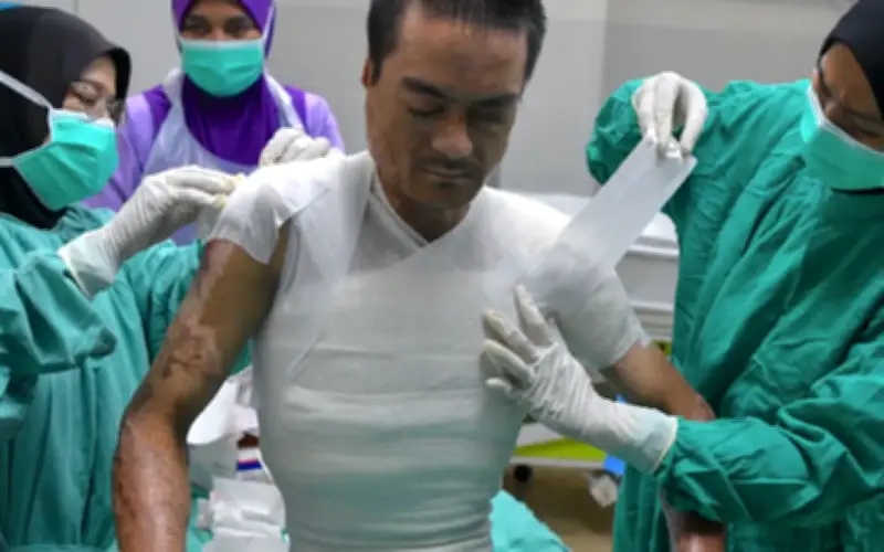 Kisah Ahmad Nasri: Perjuangan Hidup Selepas Terbakar 45% Badan