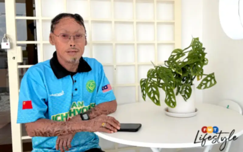Bomoh mahu bantu, kata Firdaus yang hidup dengan ichthyosis